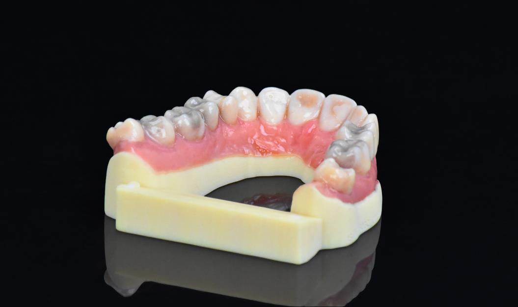 Реставрация фотополимером. Фотополимер зуботехнический. Стоматологическая 3d печать. Фотополимеры в стоматологии.
